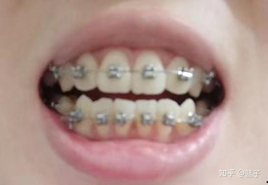 成人虎牙矫正视频,跟随视频见证蜕变之旅