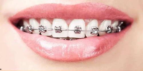 成人正畸暴利案例大全视频,真实案例分析大全